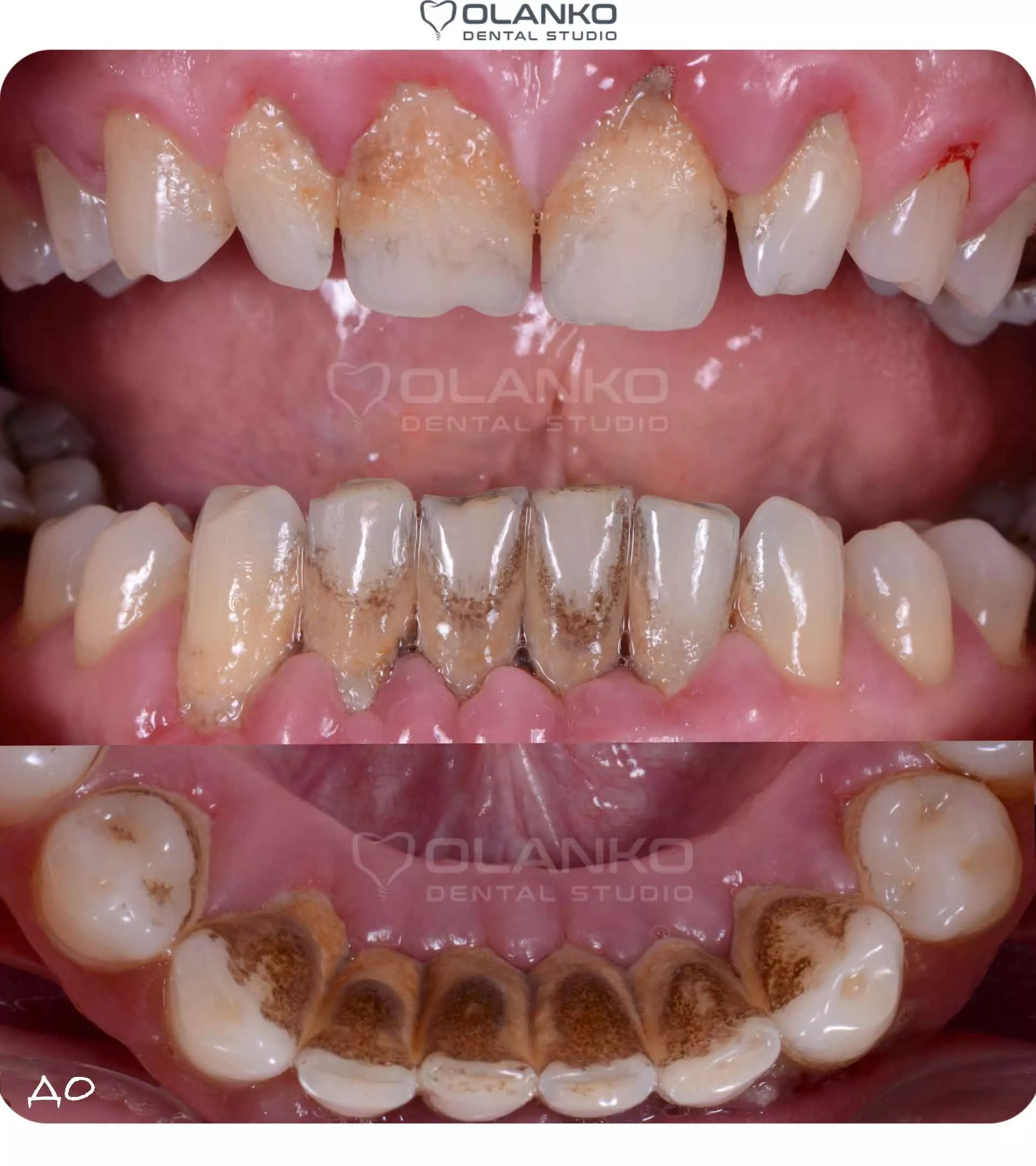 Приклад стану зубів і ясен при пародонтиті Оланко Бровари Київ