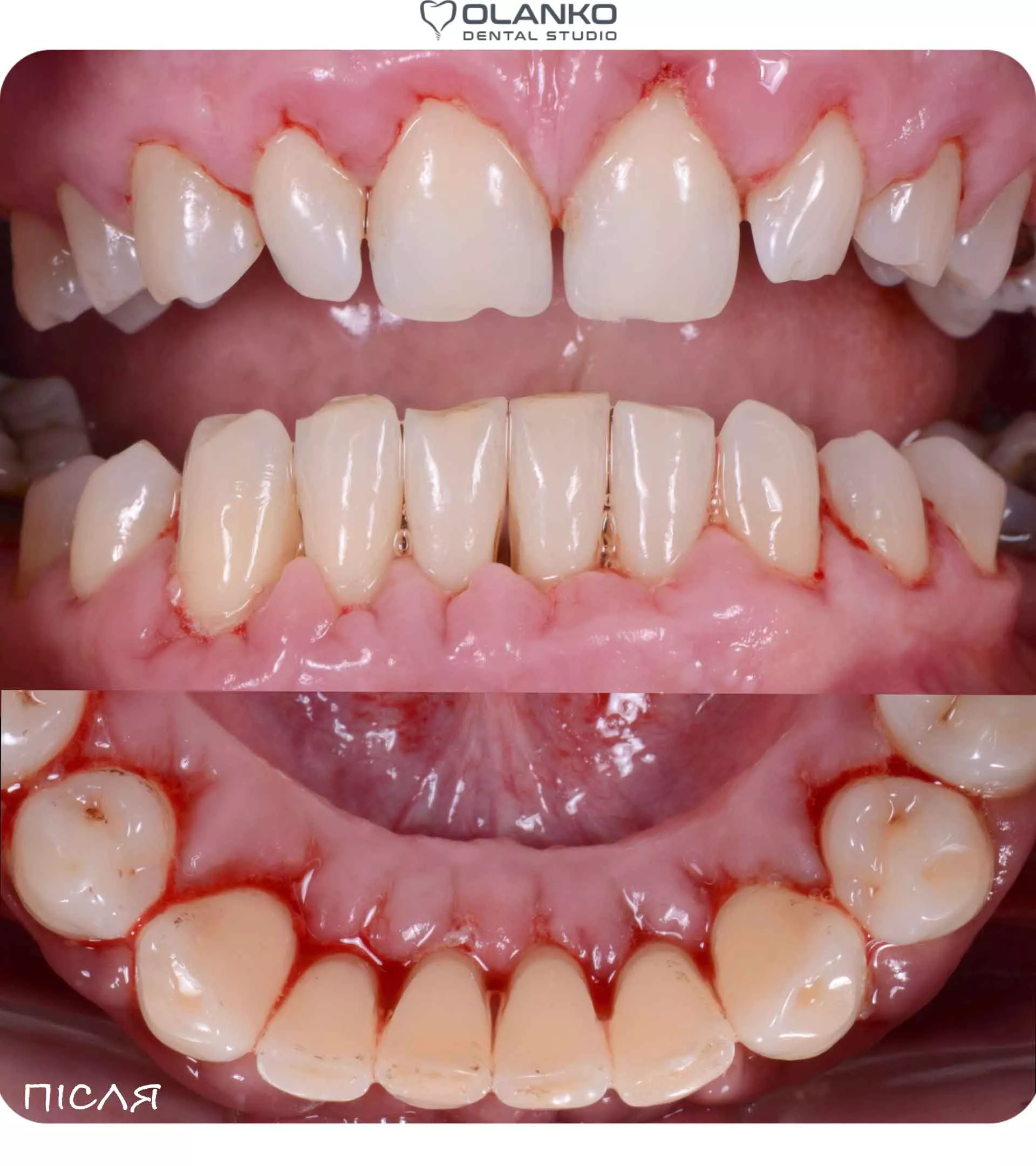 Лікування ясен пародонтиту і пародонтозу апаратом Вектор Бровари Оланко