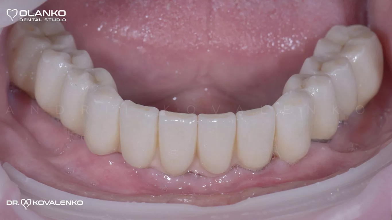 Фото після установки керамічних мостовидних протезів та коронок на імплантати на нижній щелепі