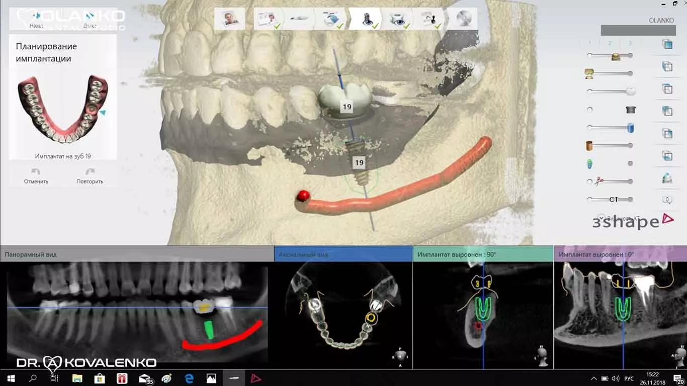 Фото планування установки імплантату в програмі Implantstudio Київ Бровари
