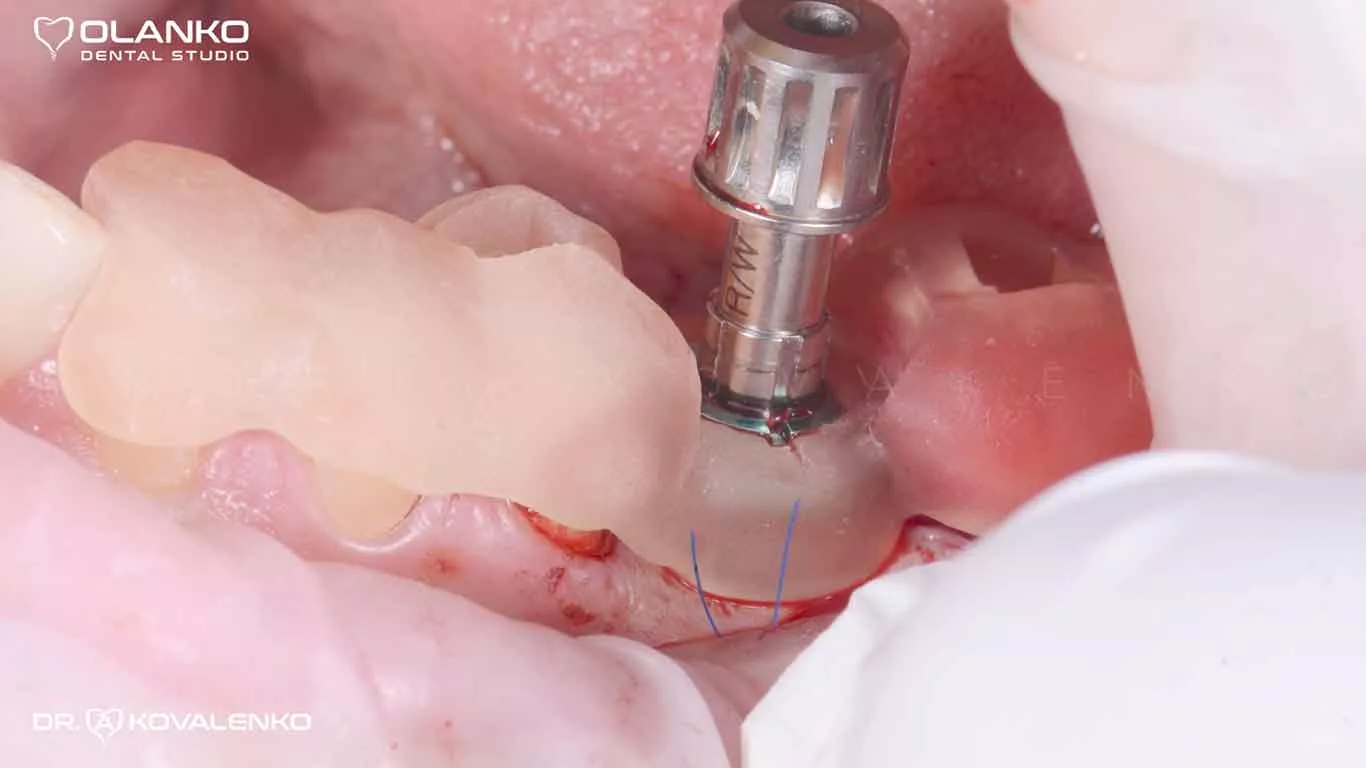 Етап 3 Фото операції&nbsp;установки імплантату через&nbsp;шаблон Київ Бровари