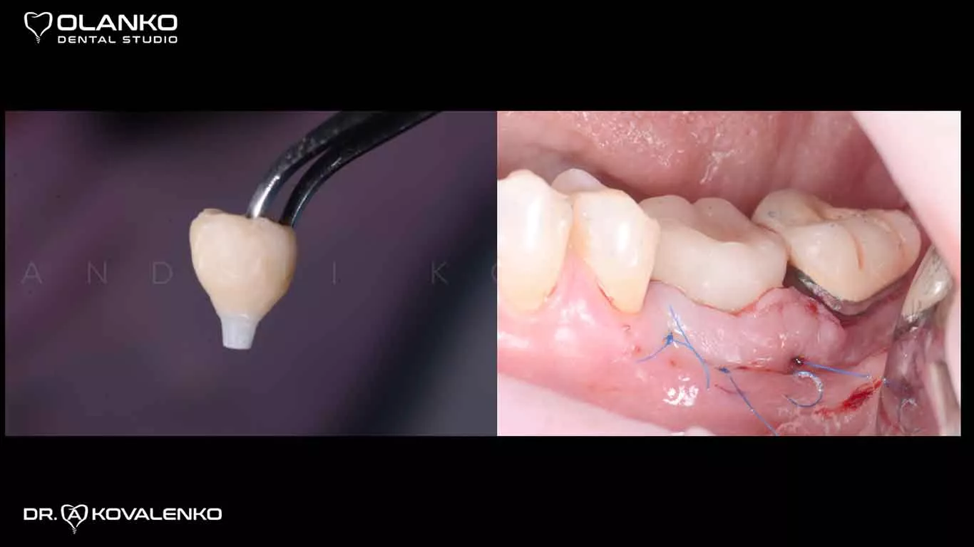 Фото&nbsp;одномоментної&nbsp;установки&nbsp;тимчасової коронки відразу після операції (експрес імплантація)