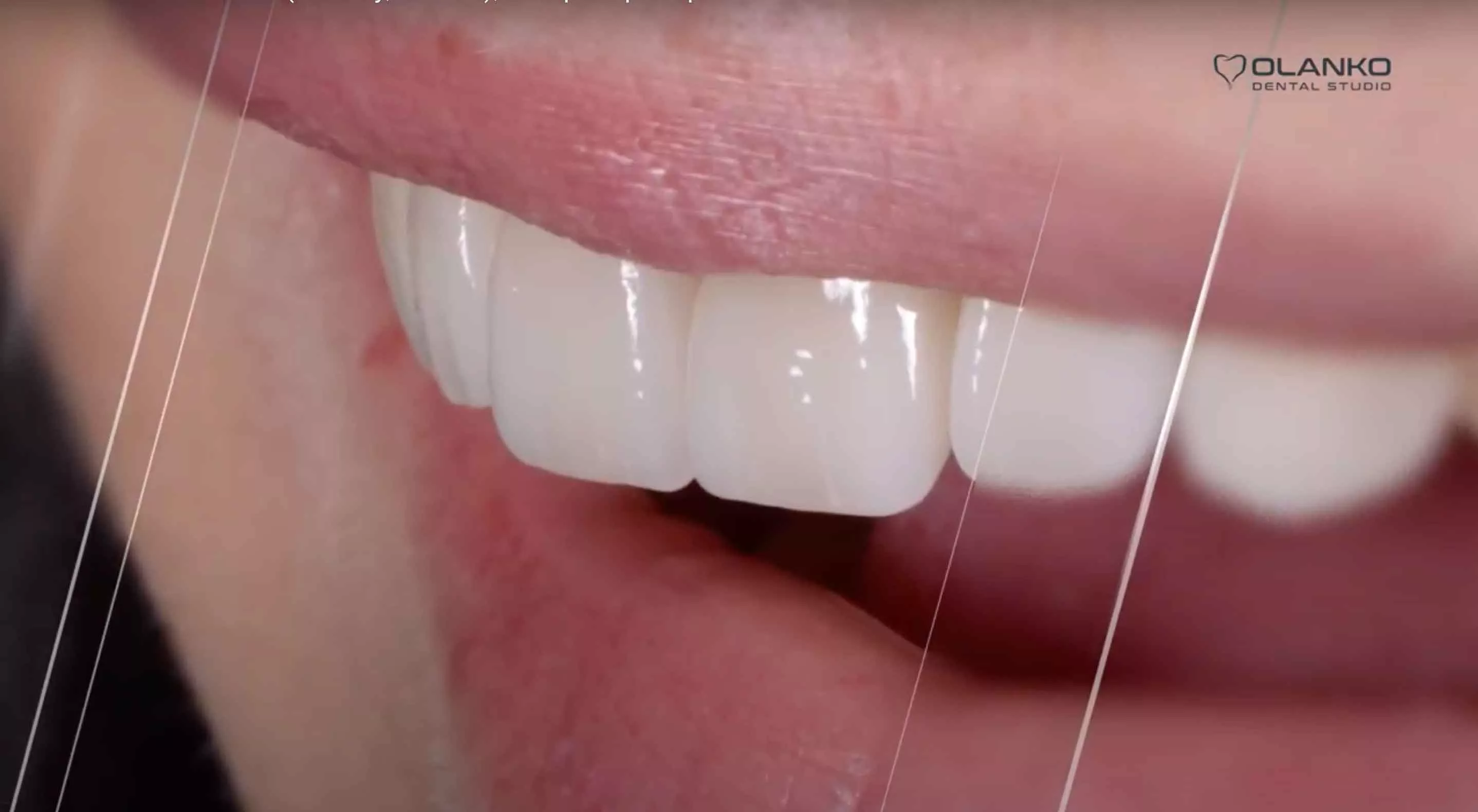 Керамічні вініри(коронки)