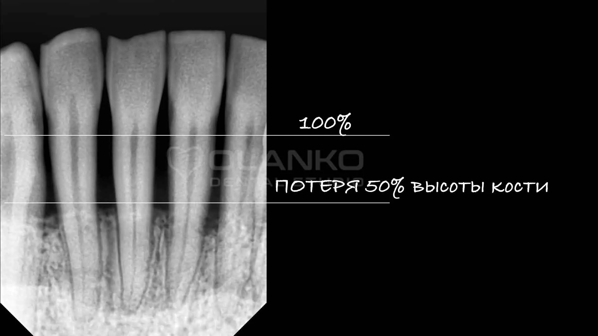 Лікування ясен пародонтиту та пародонтозу апаратом Вектор Бровари Оланко