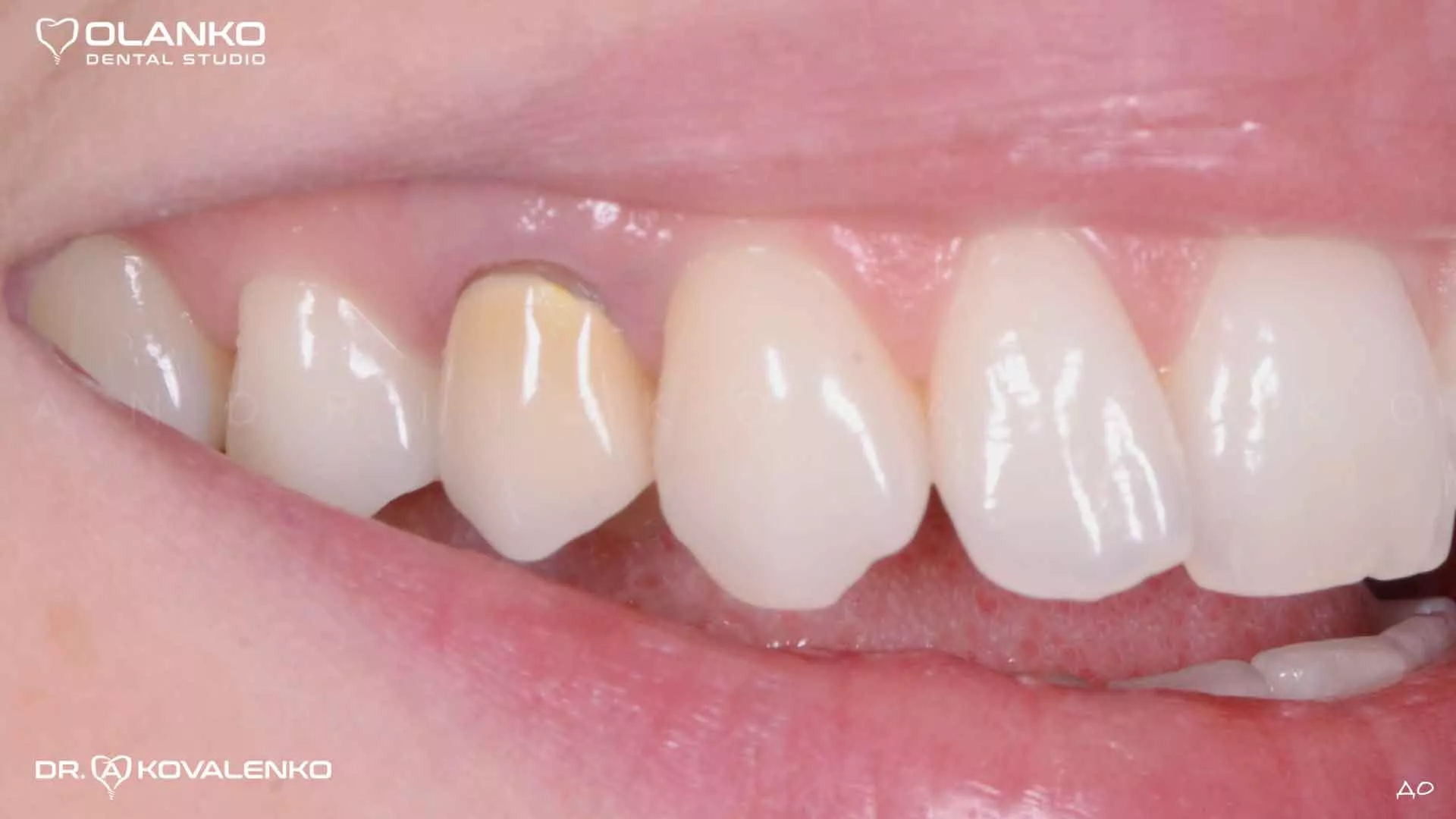 Клінічний випадок 4 Керамічні вініри(коронки)