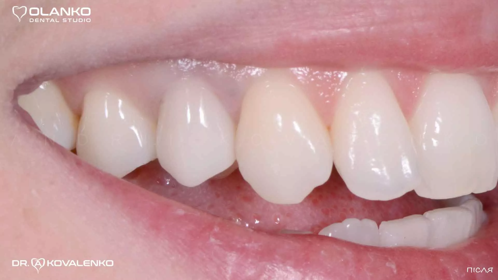 Клінічний випадок 4 Керамічні вініри(коронки)