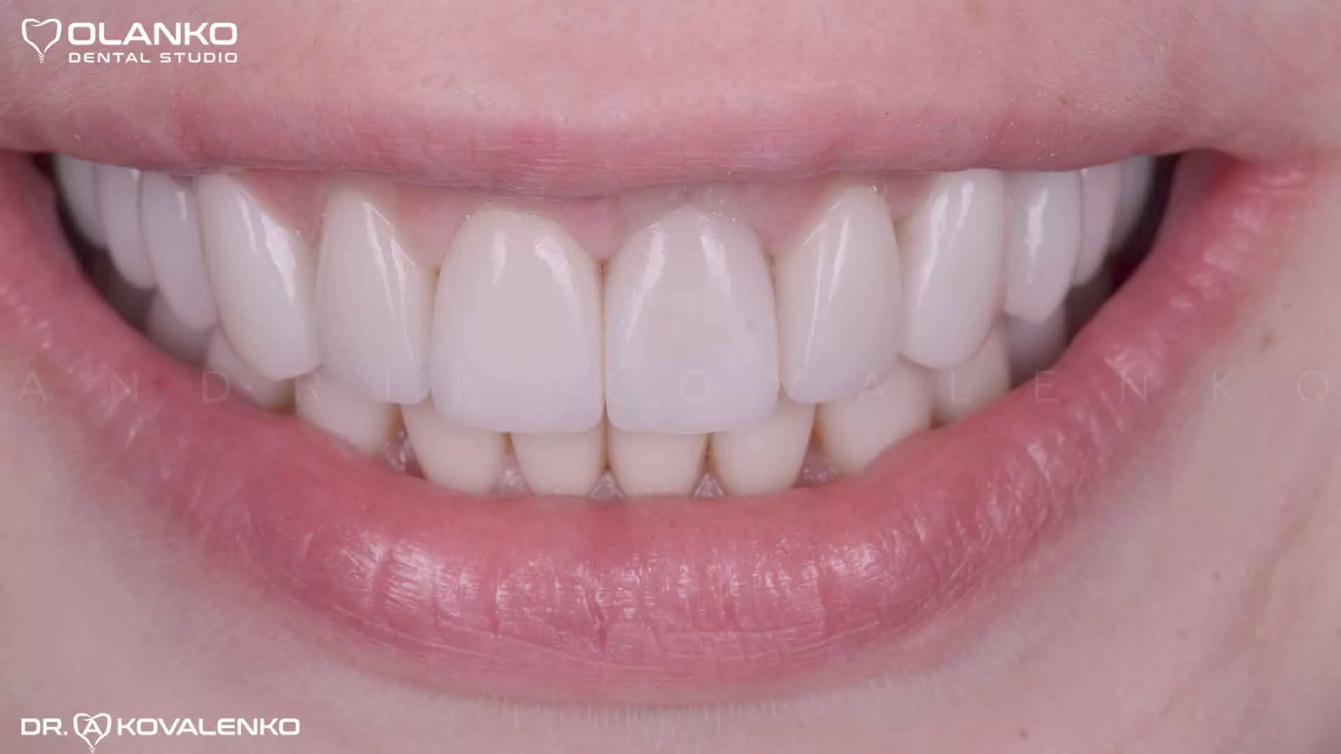 Клінічний випадок 3 Керамічні вініри(коронки)