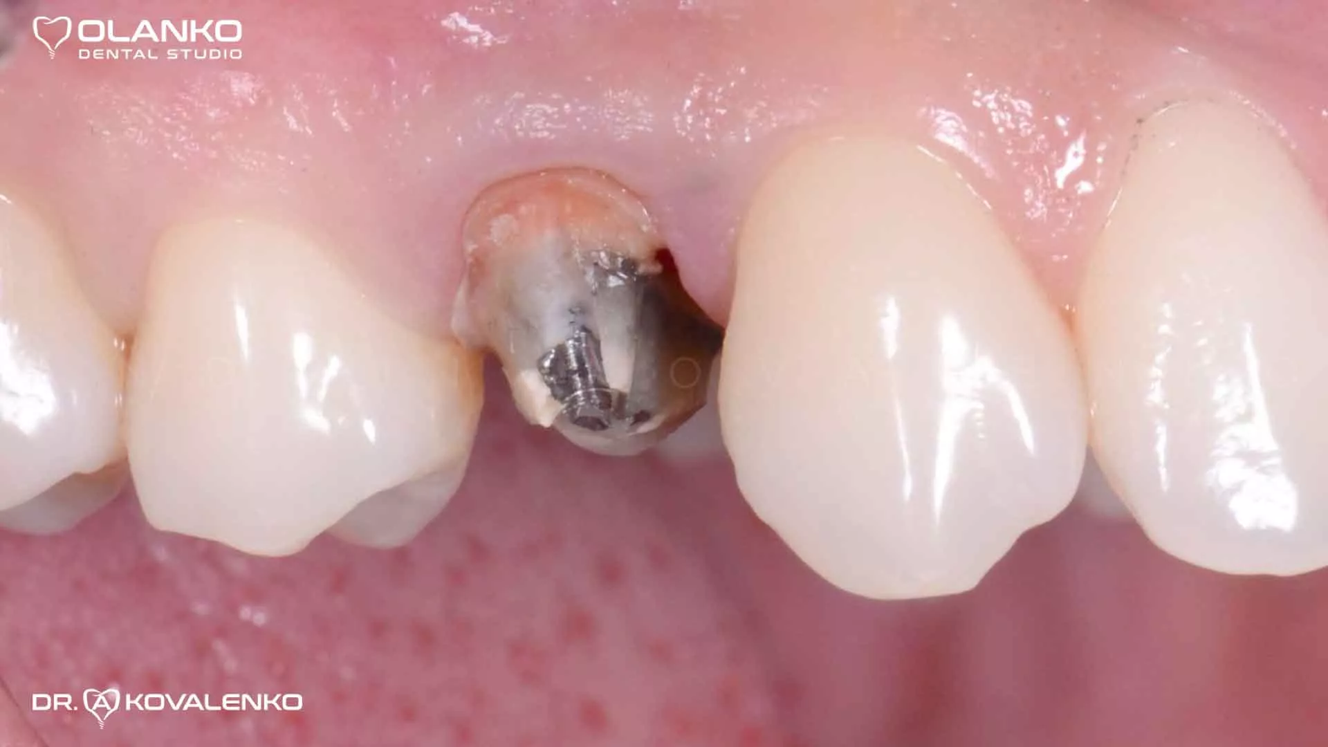 Клінічний випадок 4 Керамічні вініри(коронки)