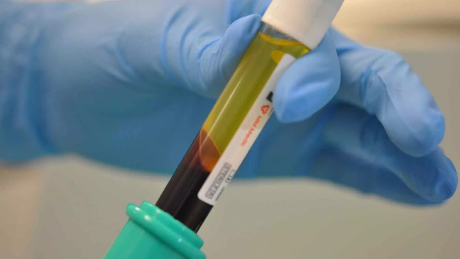 Плазмоліфтинг стоматологічний - Ін'єкції для зміцнення ясен | Оланко Бровари Київ