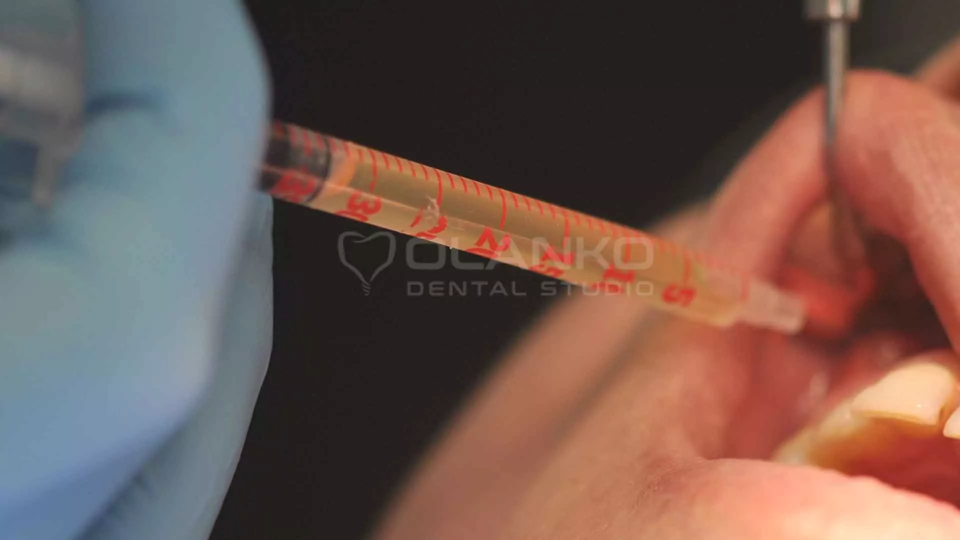 Введення фракції тромбоцитарної&nbsp;аутоплазми&nbsp;в ясна Оланко Бровари Київ