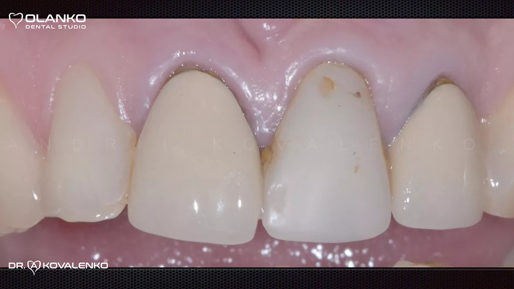 Клінічний випадок 1 Керамічні вініри(коронки)