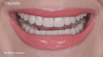 Функціонально-естетичне протезування зубів