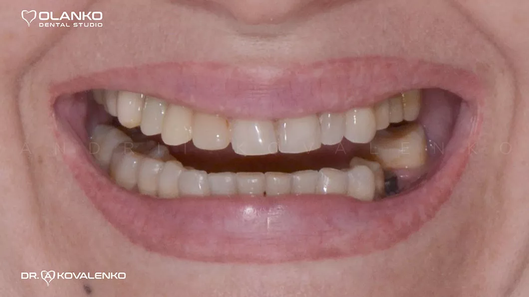 Клінічний випадок 4 протезування