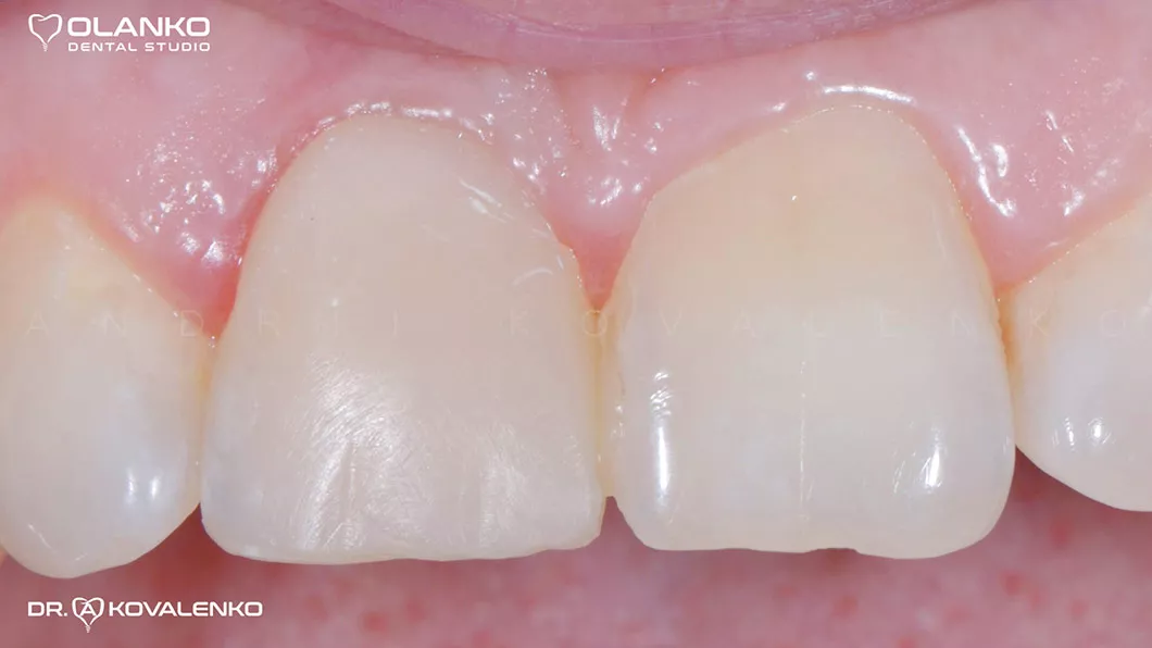 Клінічний випадок 5 імплантація