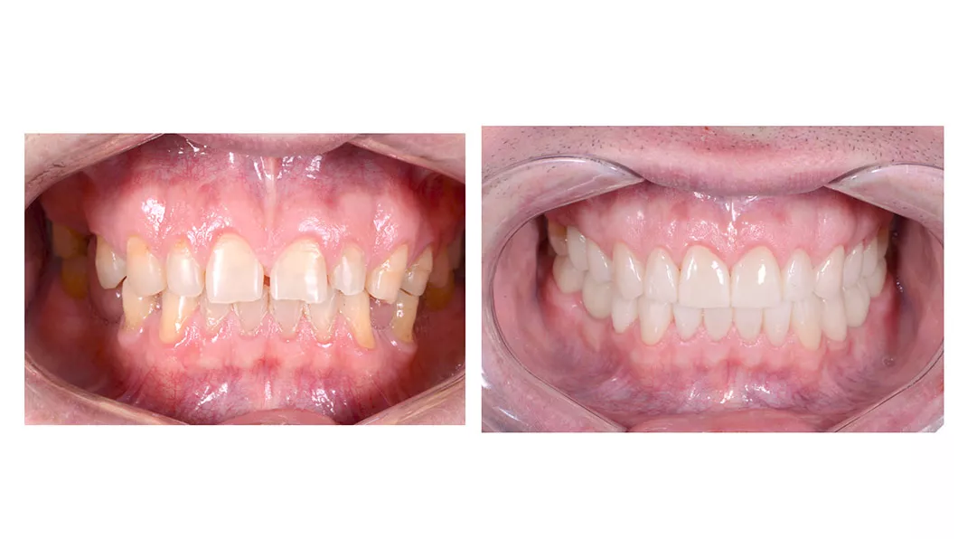 Клінічний випадок 2 протезування