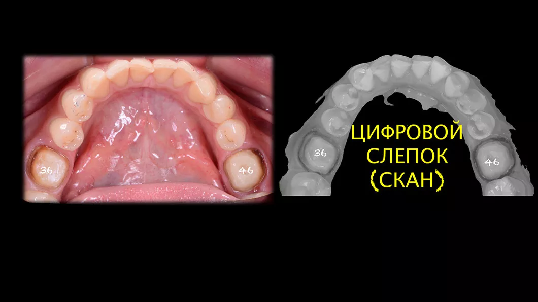 Цифрова стоматологія методом&nbsp;Оланко Бровари Київ