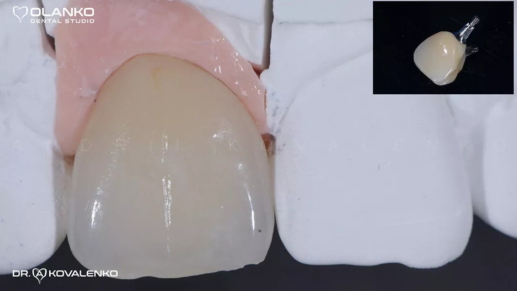 Клінічний випадок 5 імплантація