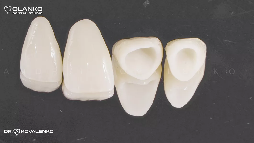 Клінічний випадок 1 Керамічні вініри(коронки)