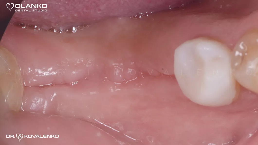 Клінічний випадок 4 імплантація