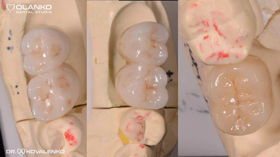 Клінічний випадок 2 імплантація