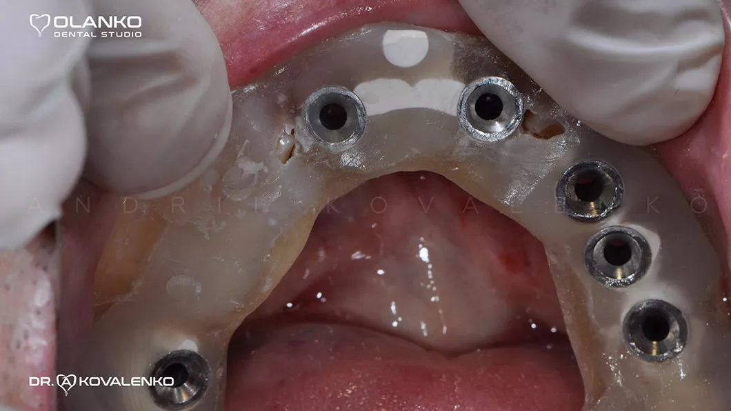 Клінічний випадок 1 імплантація