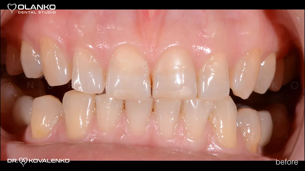 Клінічний випадок 1 протезування