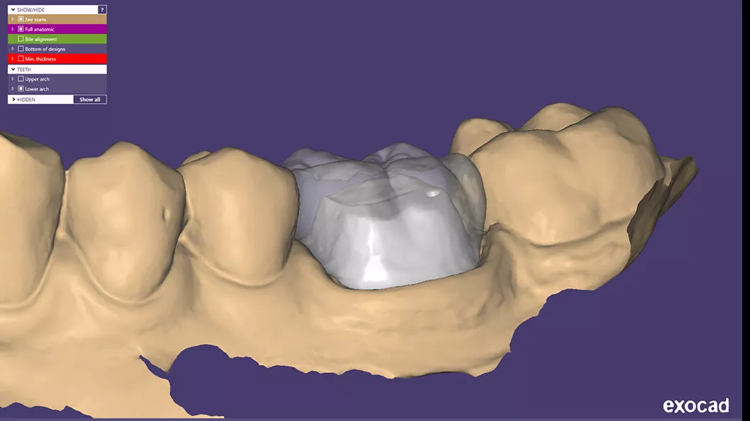 Цифрова стоматологія методом&nbsp;CAD/CAM Бровари Київ Оланко