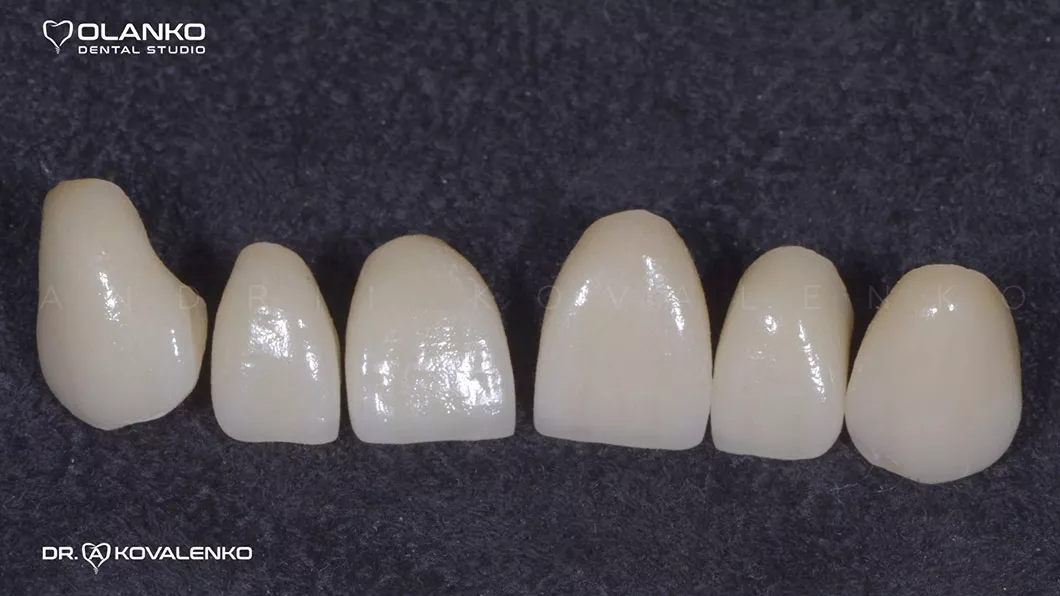 Клінічний випадок 1 імплантація