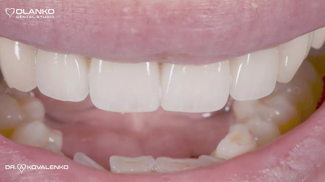 Клінічний випадок 1 Керамічні вініри(коронки)