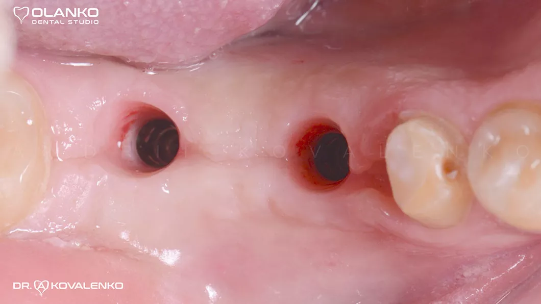 Клінічний випадок 4 імплантація