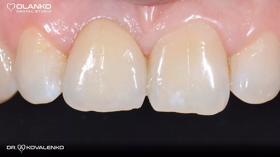 Клінічний випадок 5 імплантація