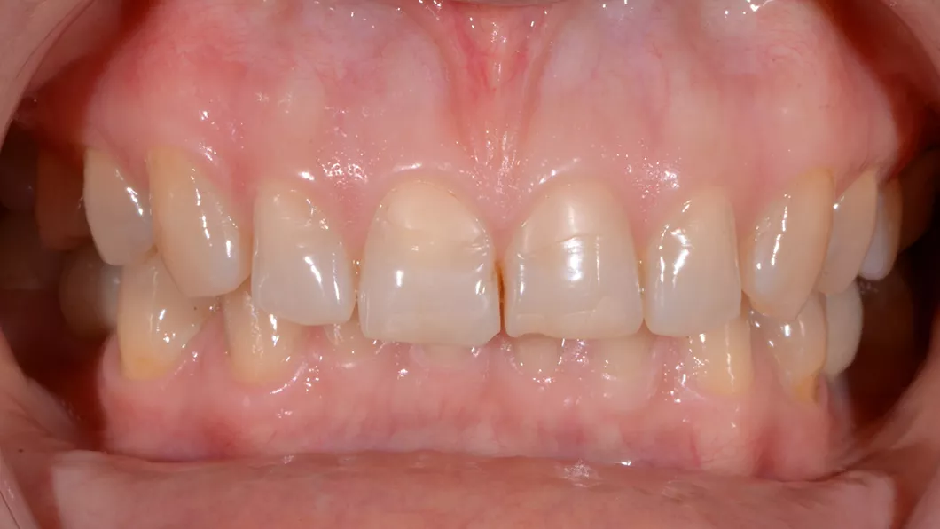 Клінічний випадок 1 протезування