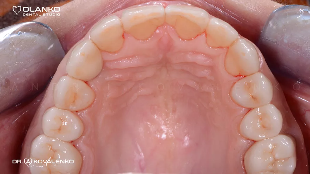 Клінічний випадок 3 протезування