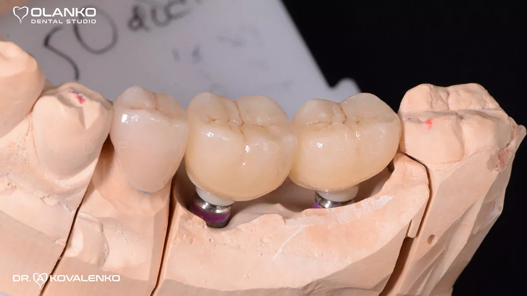 Клінічний випадок 4 імплантація