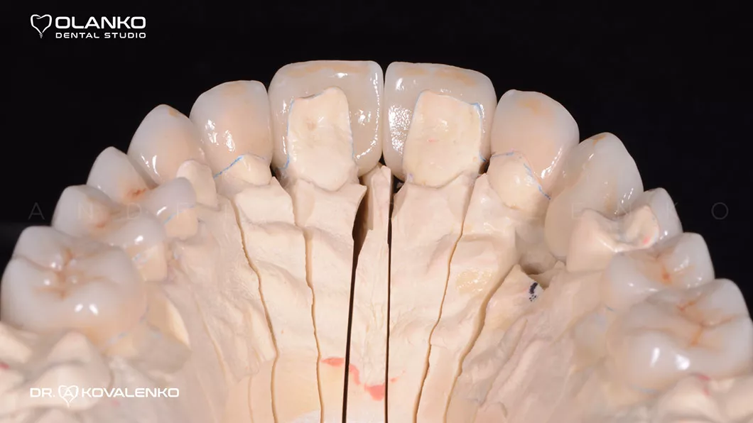 Клінічний випадок 3 протезування