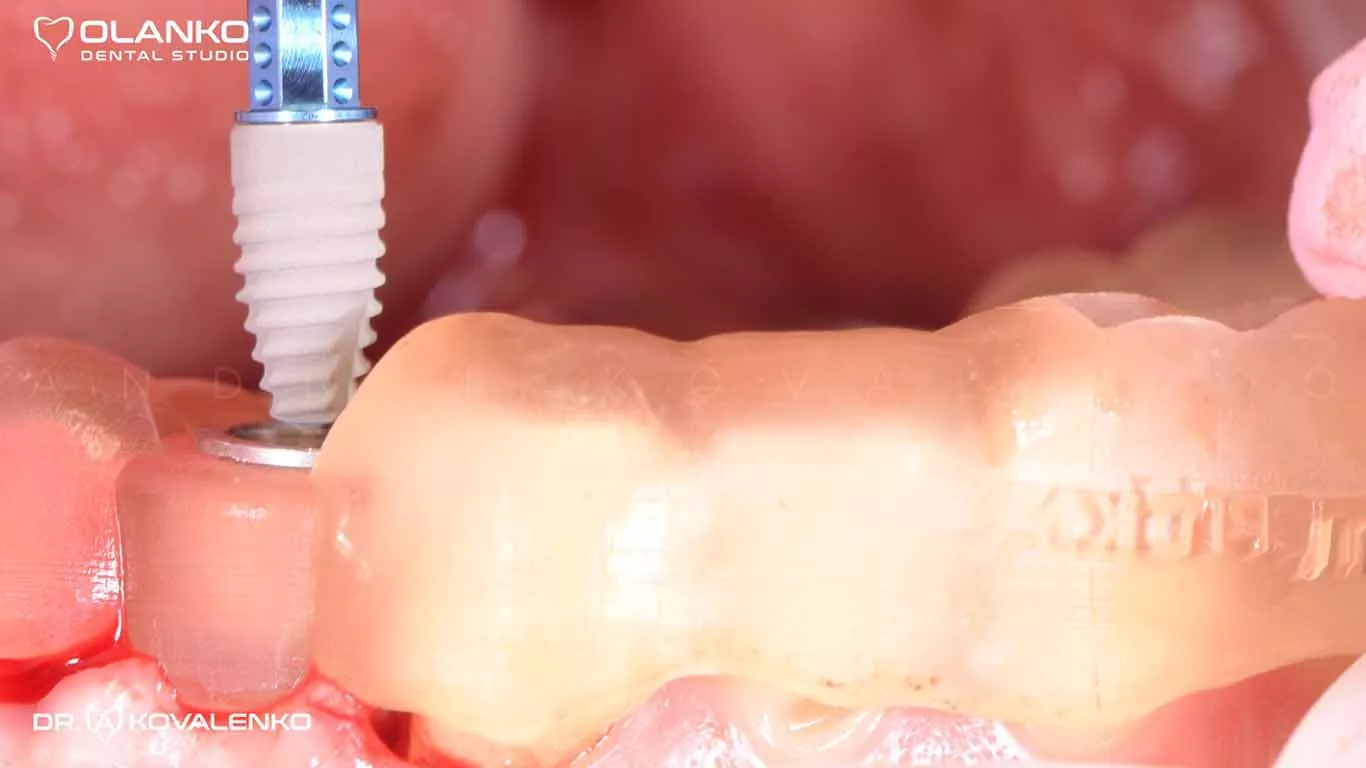 Фото імпланта&nbsp;Straumann під час установки за допомогою&nbsp;&nbsp;шаблона