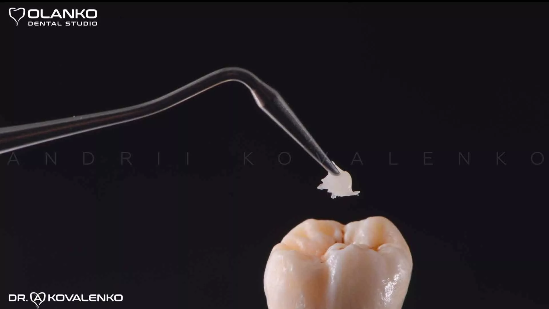 Цілі та&nbsp;результат реставрації зубів Оланко