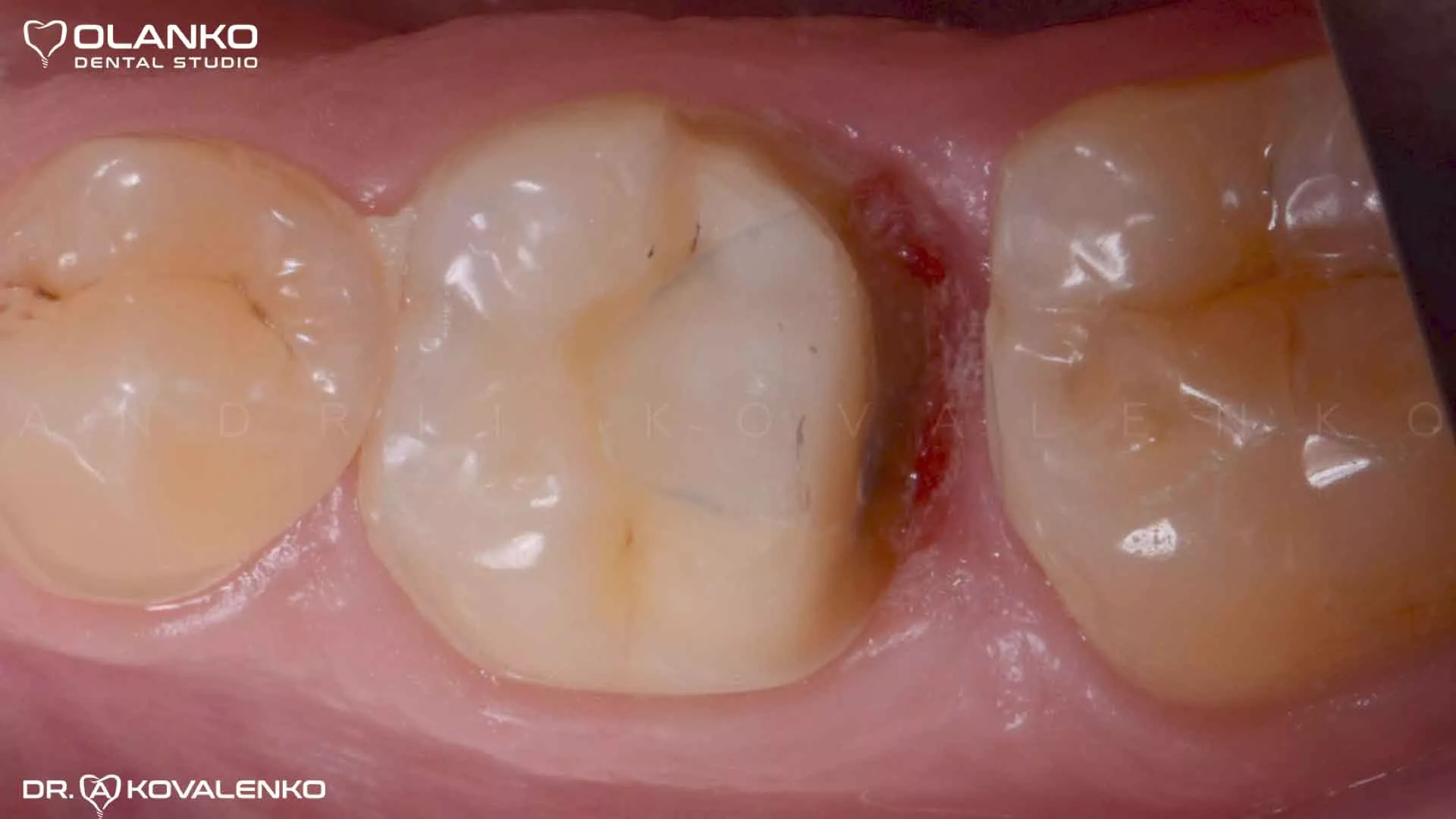 керамічна вкладка