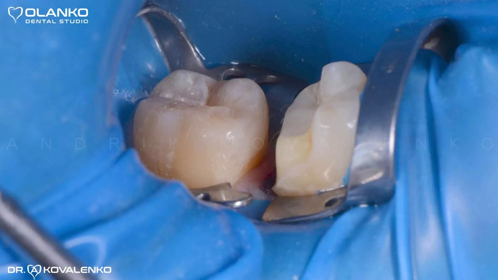 керамічна вкладка