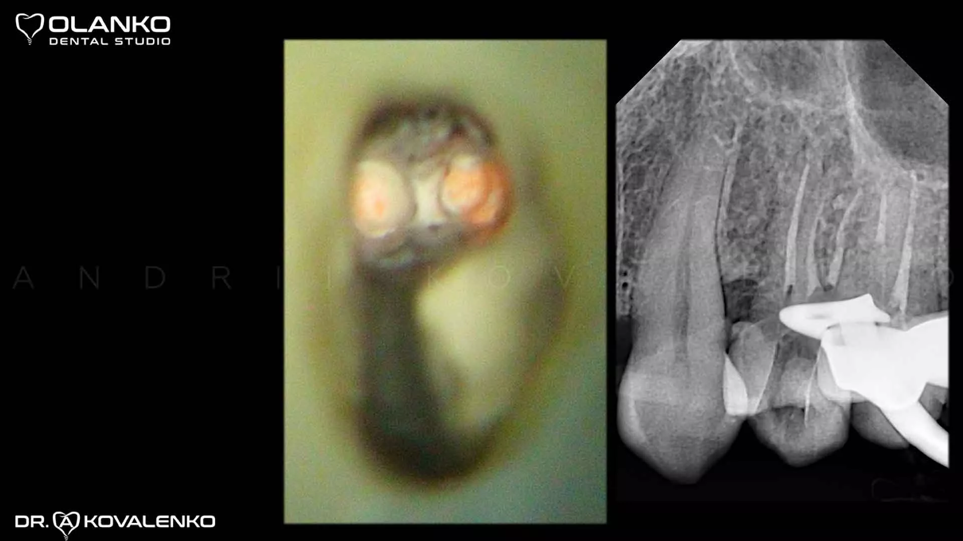 Клінічний випадок 3 лікування каналів