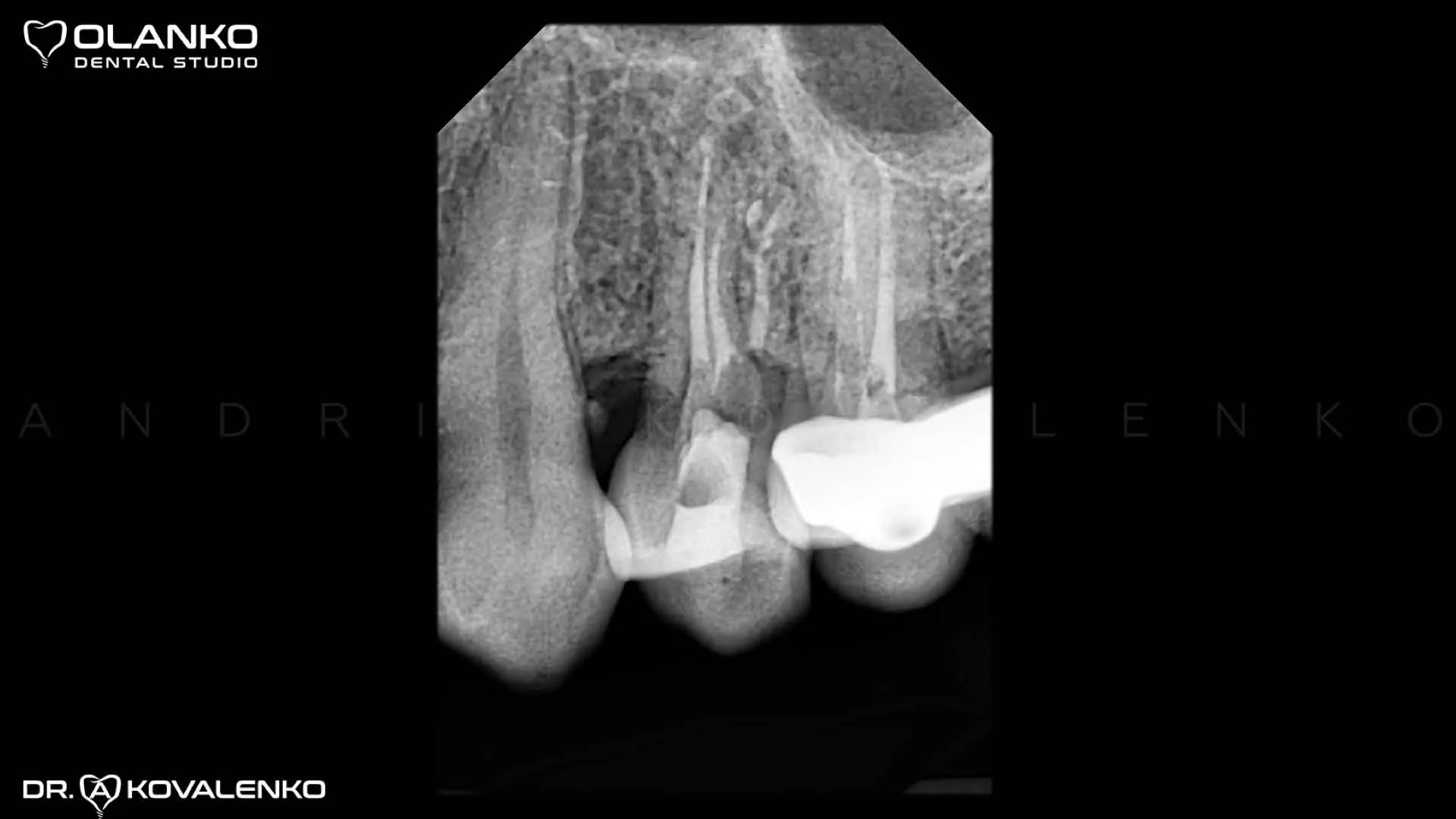 Клінічний випадок 3 лікування каналів