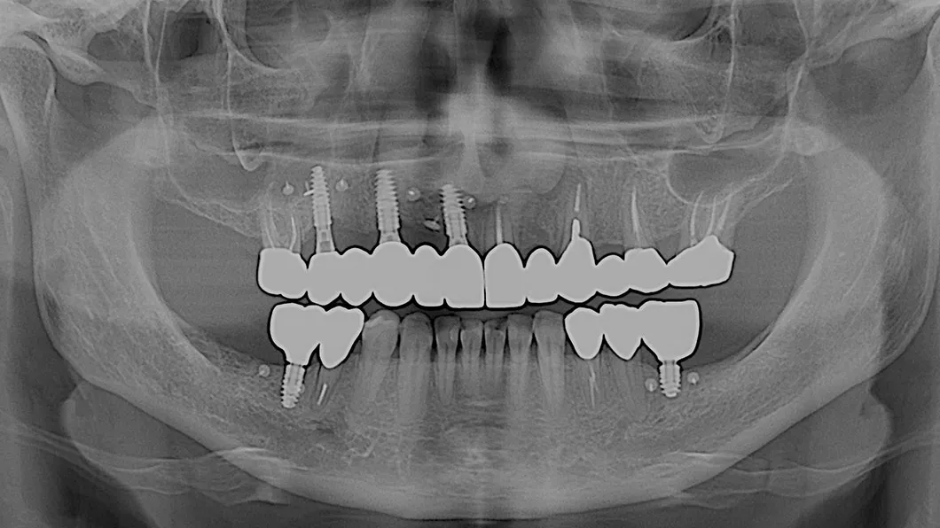 Клінічний випадок 3 імплантація