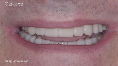 Імплантація зубів,приклади робіт до та після.Фотогалерея імплантація зубів.