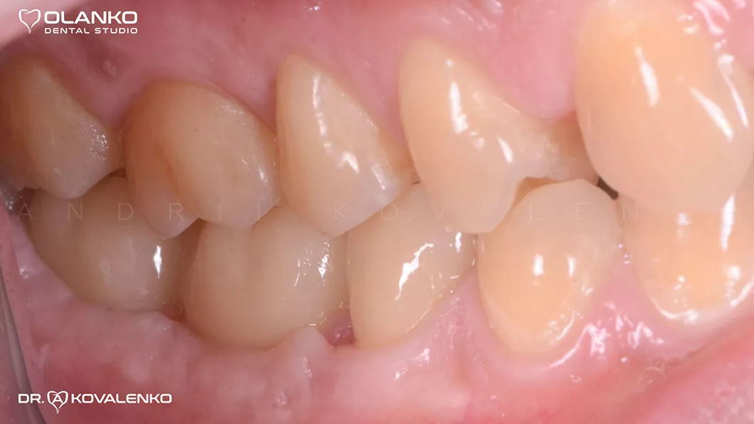 Клінічний випадок 4 імплантація