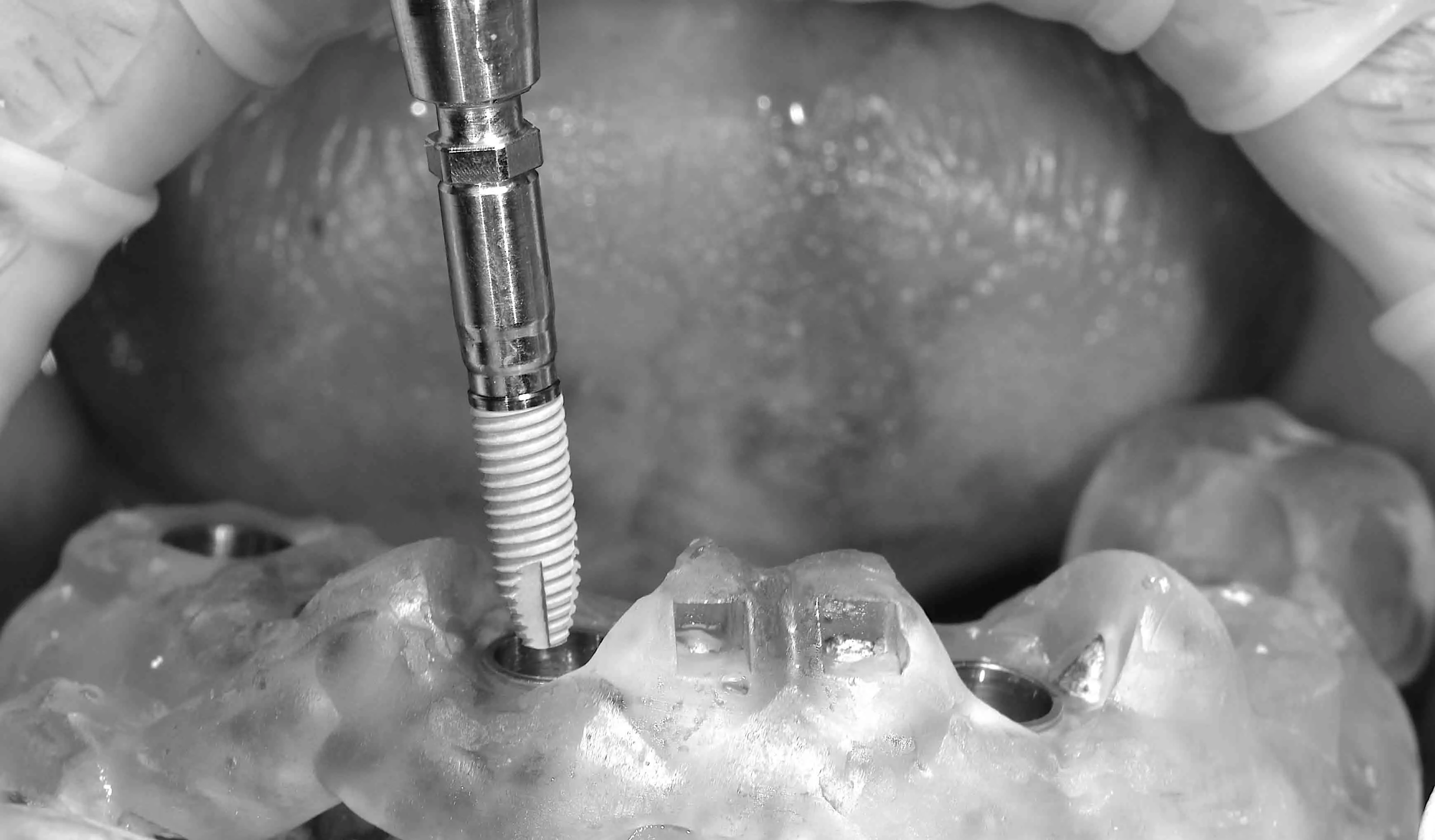 Імпланти Nobel система номер 1 в світі.