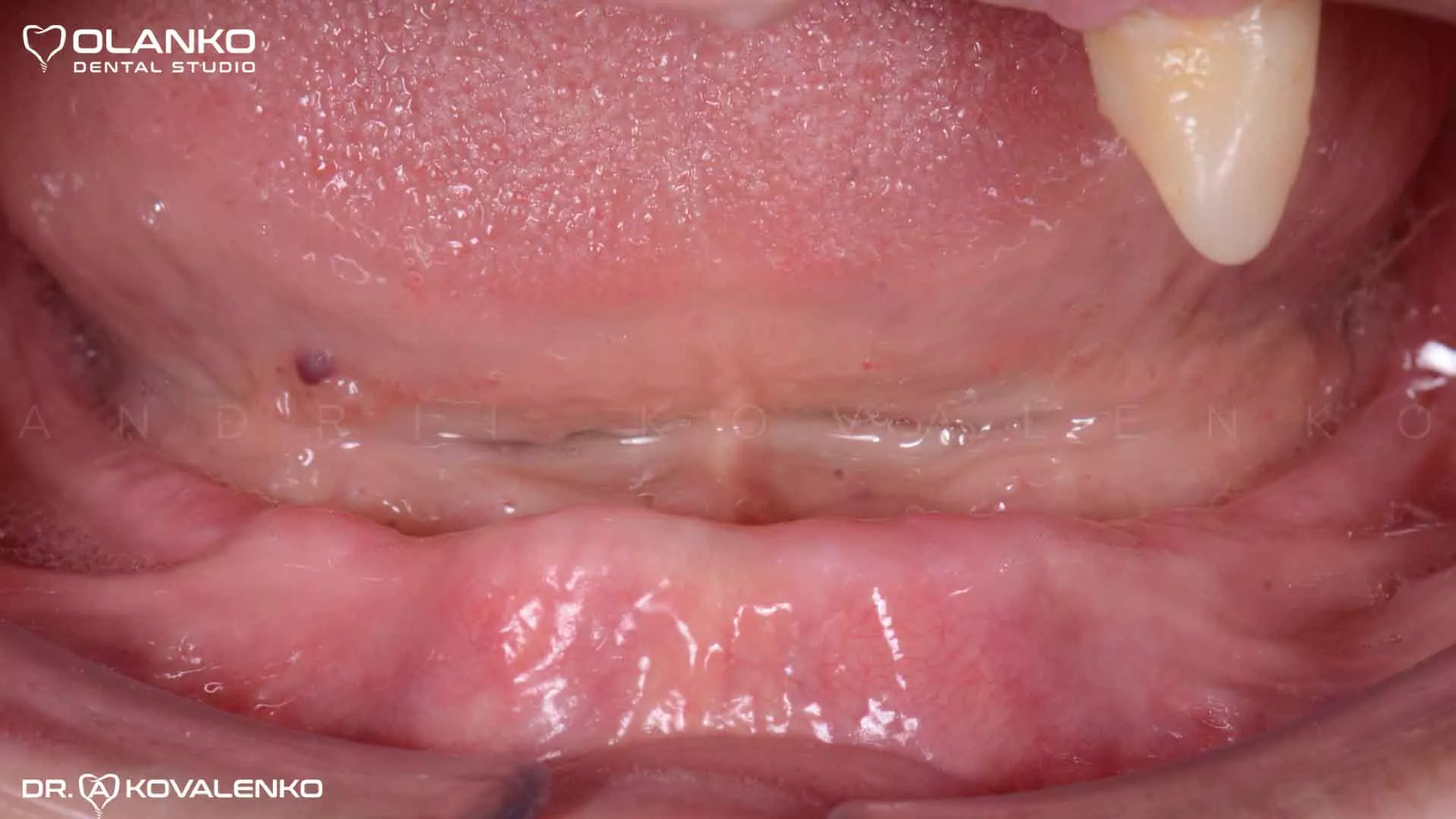 Клінічний віпадок 9 імплантація