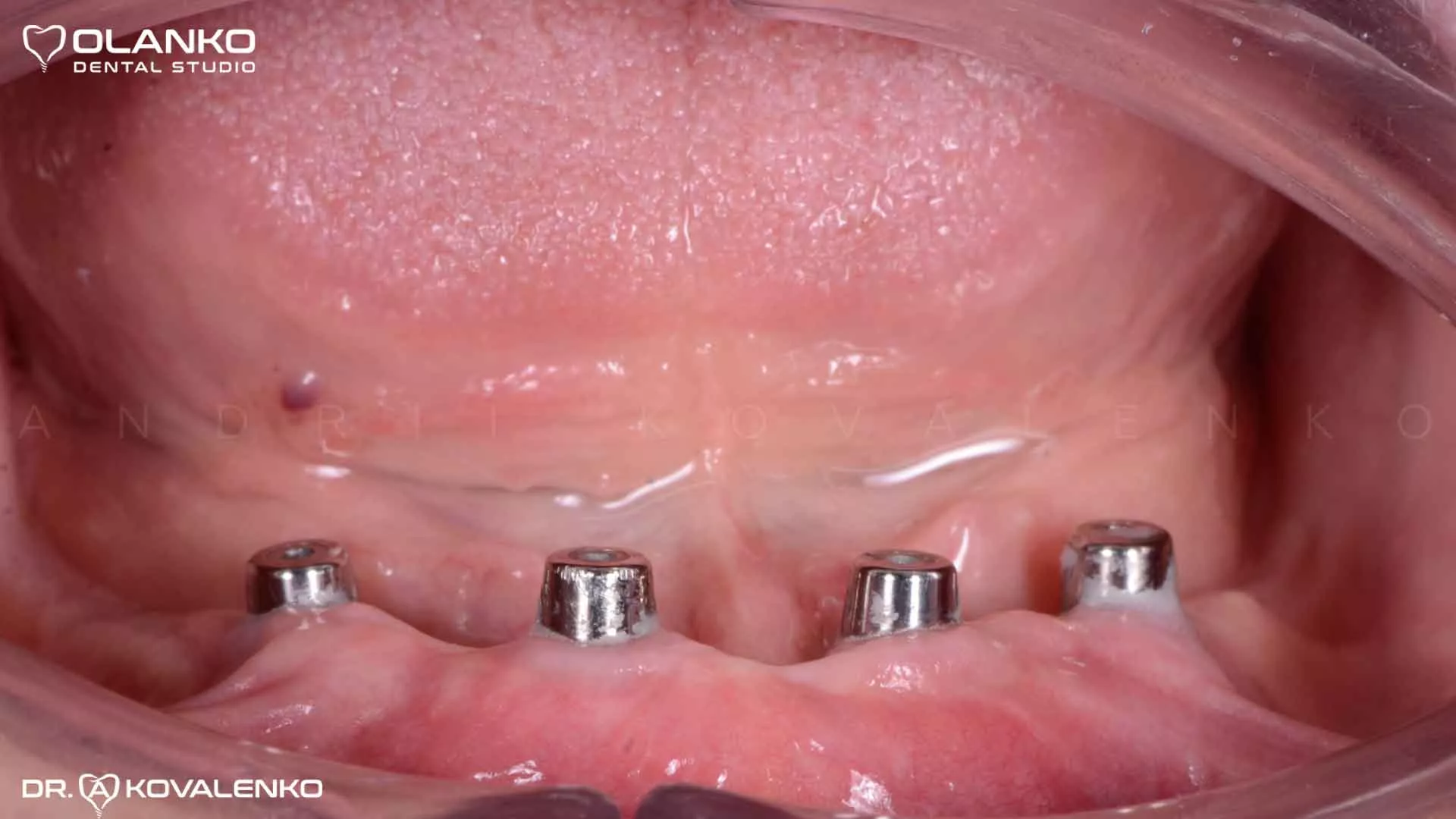 Клінічний віпадок 9 імплантація