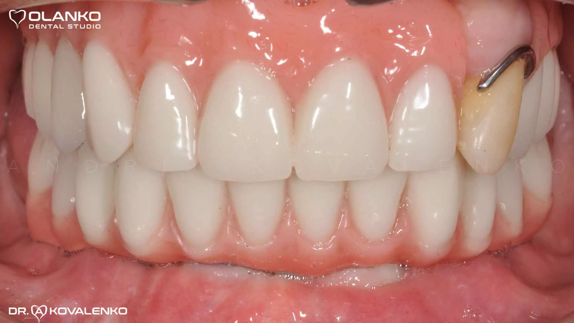 Клінічний віпадок 9 імплантація