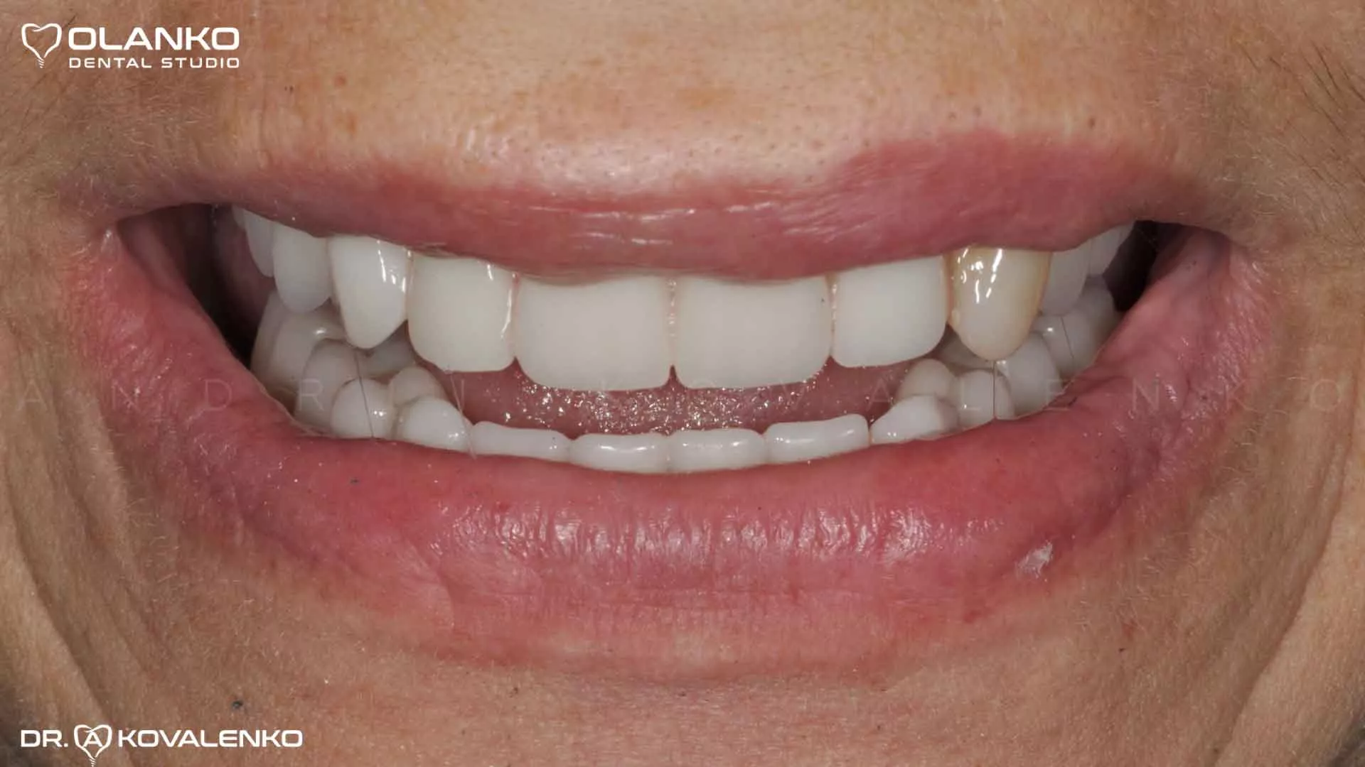 Клінічний віпадок 9 імплантація