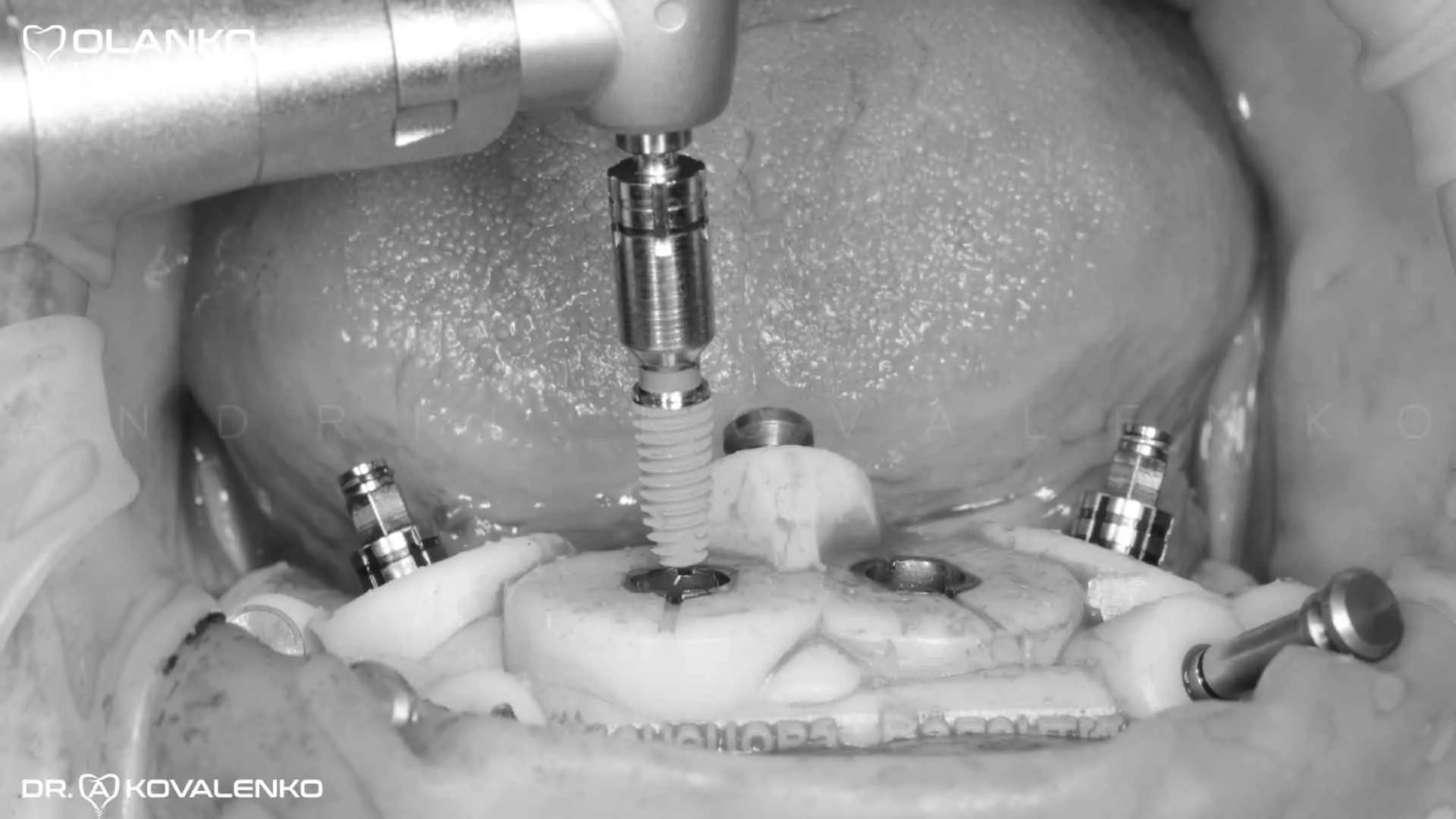 Клінічний віпадок 9 імплантація